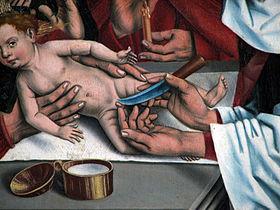 Circumcision