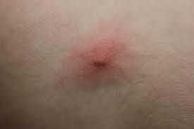 download mango fly removal